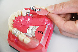 東大前歯科クリニック:リーゲルテレスコープ（義歯）