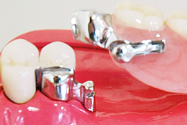 東大前歯科クリニック:リーゲルテレスコープ（義歯）
